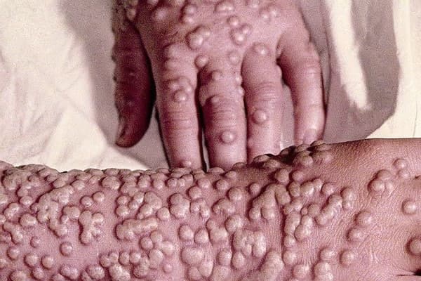 تعبیر خواب آبله