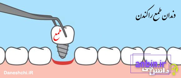 ضرب المثل دندان طمع را کندن