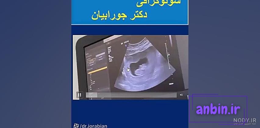 تصاویر سونوگرافی در سه ماهه ی دوم بارداری - هفته چهاردهم تا هجدهم -  سونوگرافی صدرا