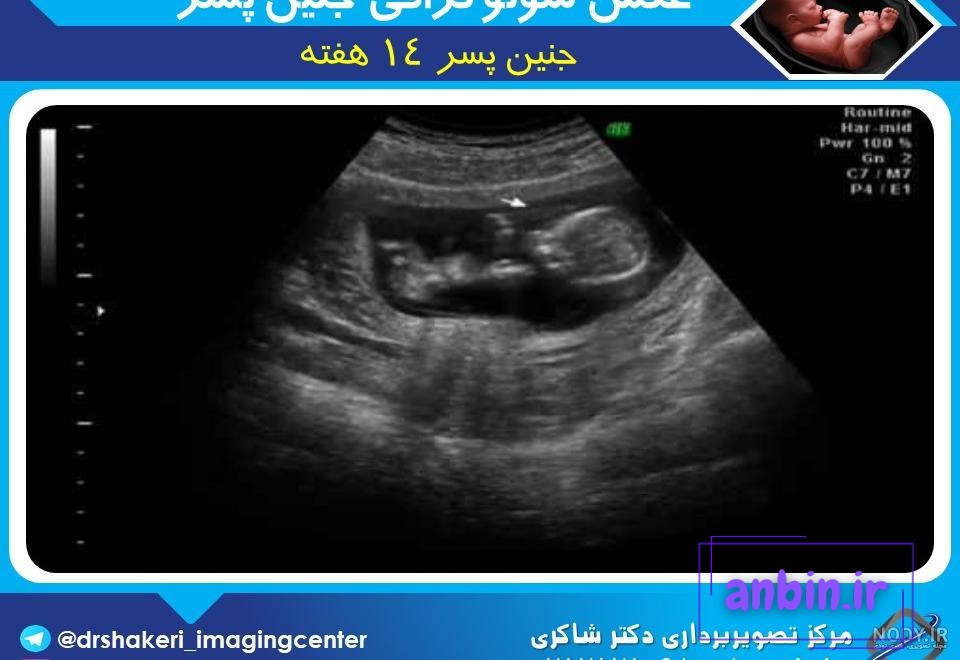 عکس سونوگرافی جنین پسر برای پروفایل